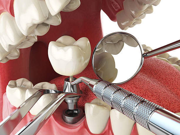Best Emergency Tooth Extraction in Clay City, KY